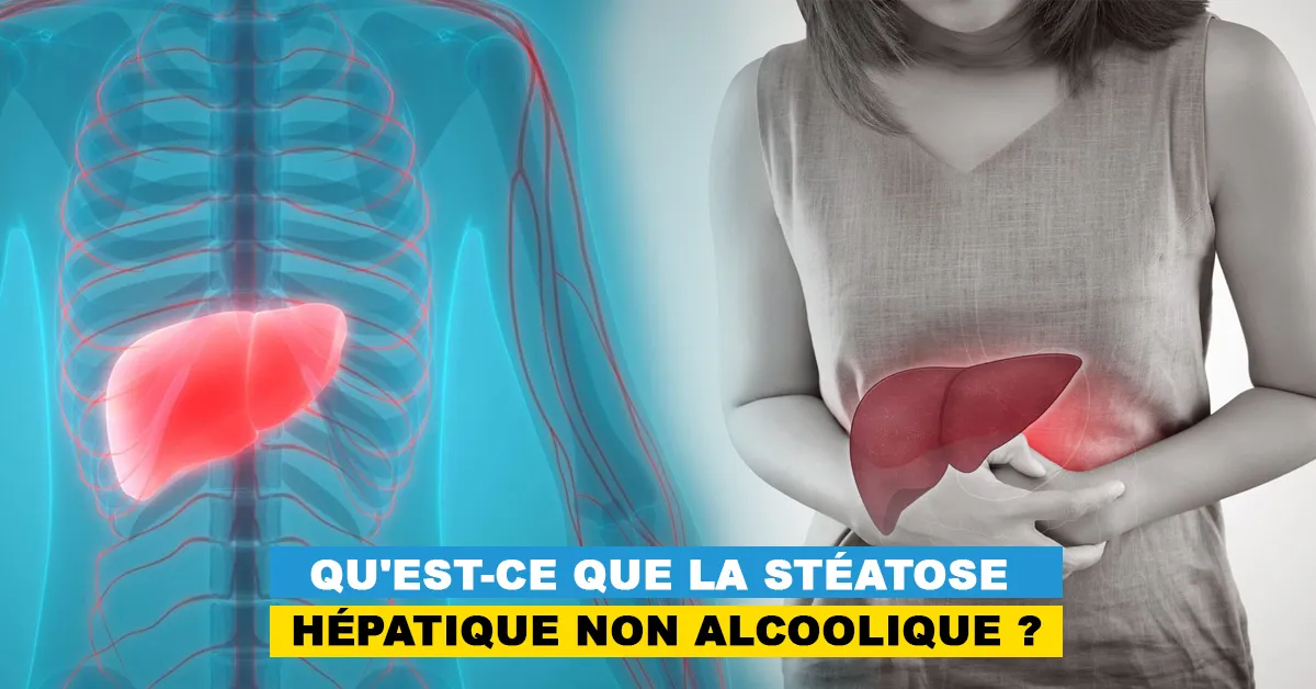 Qu'est-ce que la stéatose hépatique non alcoolique ?